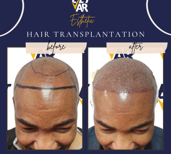 Hair Transplant 