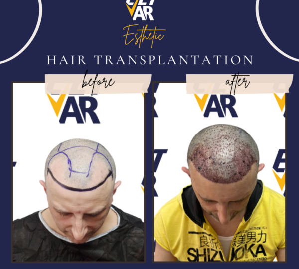Hair Transplant 
