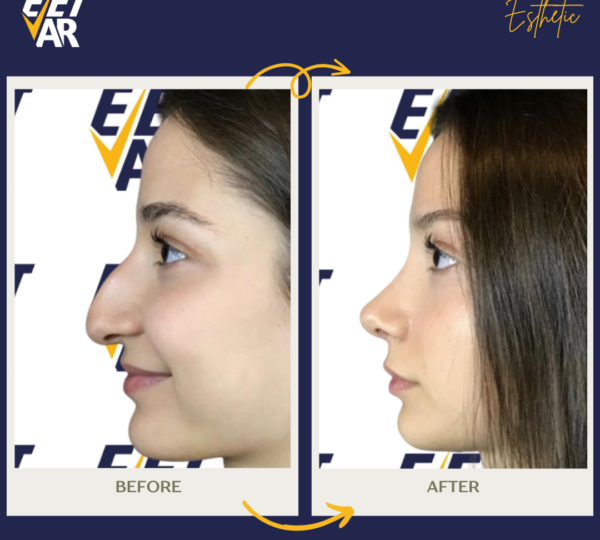 Rhinoplasty