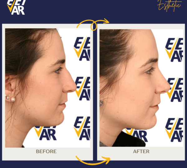 Rhinoplasty