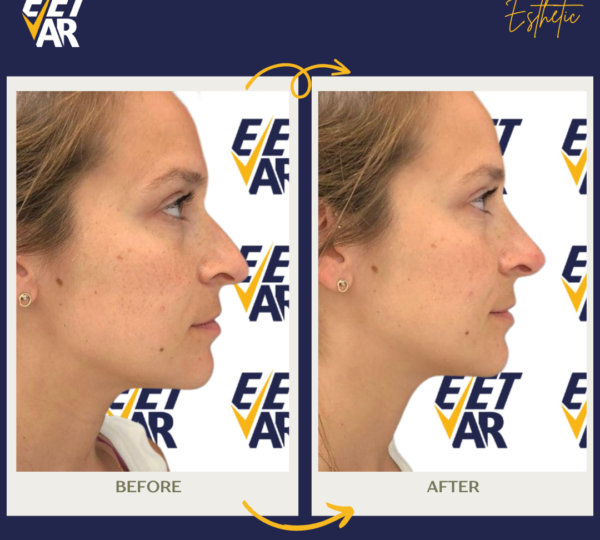 Rhinoplasty